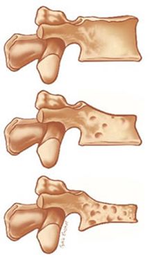 Normaler Wirbel und zusammengedrückte Wirbel